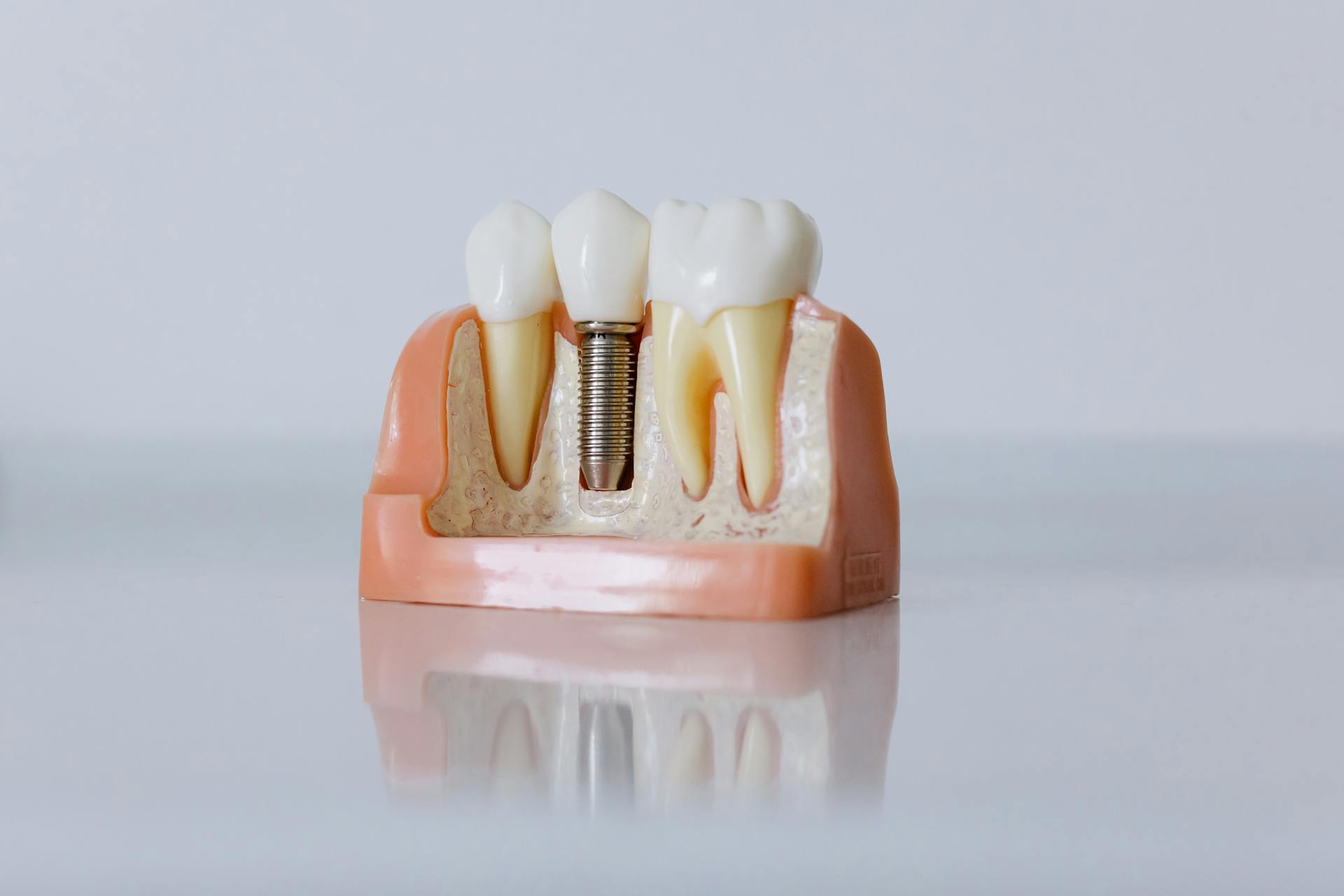 Ce investigații trebuie realizate înainte de procedura cu implantul dentar